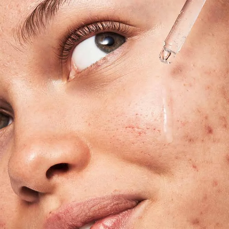 e.l.f. Blemish Breakthrough Triple-Acid Resurfacing Serum Discontinued